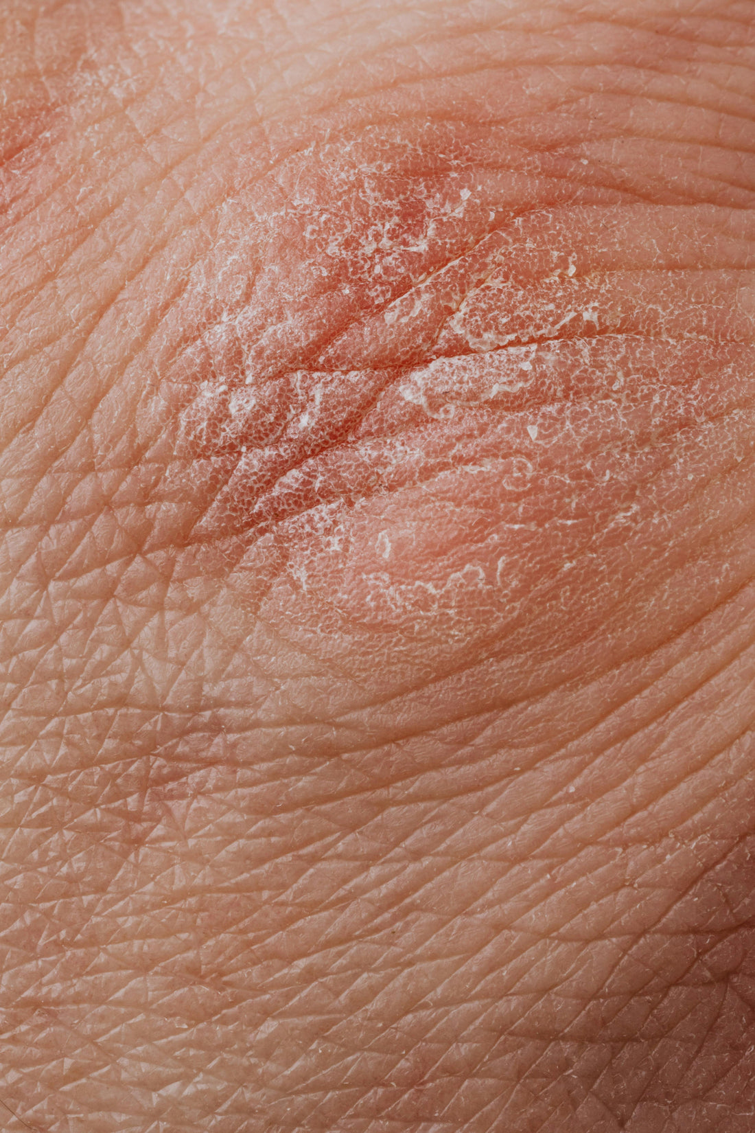 Psoriasis, el Intestino y un Componente Estructural Faltante